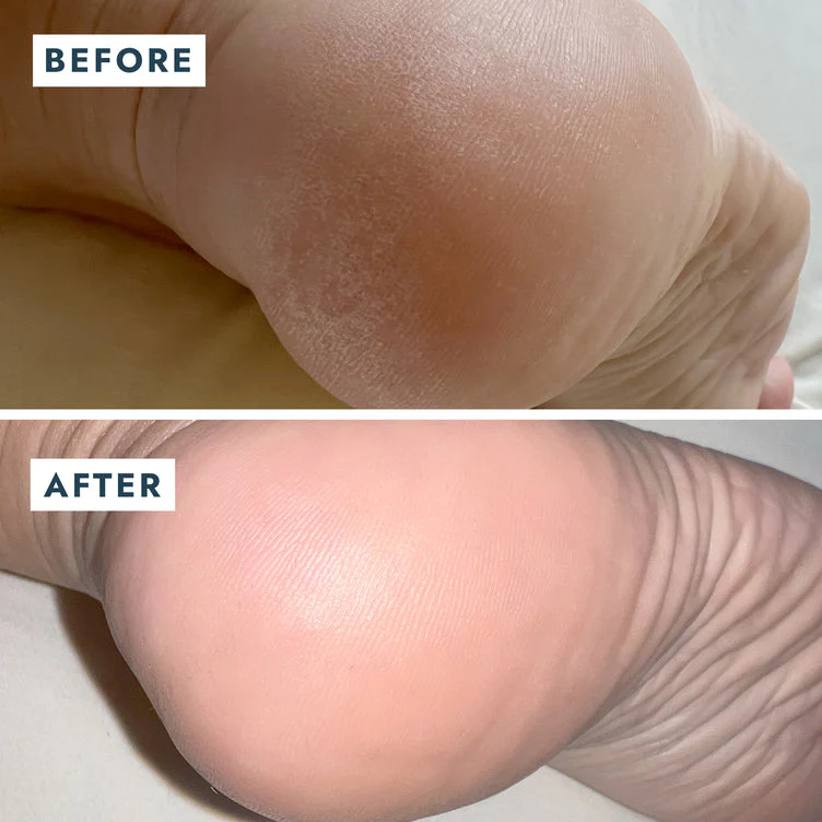 VOESH Heel Repair Duo - Repair Balm + Heel Socks - Image 4